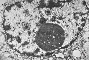 M,5y. | activated nucleolus - Reye hepatocerebral syndrome